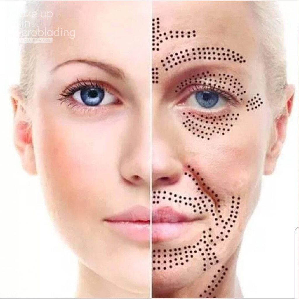 Căng da mặt bằng Plasma Fibroblast