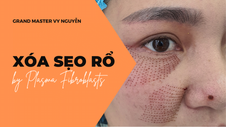 plasma fibroblast là gì - yt xoa xeo ro plasma