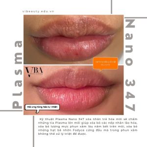 xóa nếp nhăn môi - Plasma fibroblast nano 347 xoa nep nhan moi 1