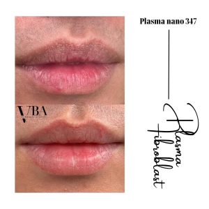 Plasma Fibroblast - xóa nếp nhăn môi hiệu quả 3 xóa nếp nhăn môi - Plasma fibroblast nano 347 xoa nep nhan moi 10