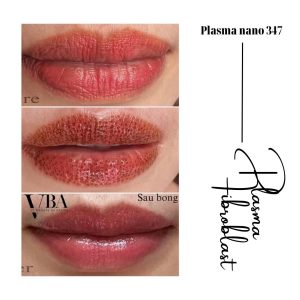 Plasma Fibroblast - xóa nếp nhăn môi hiệu quả 5 xóa nếp nhăn môi - Plasma fibroblast nano 347 xoa nep nhan moi 12