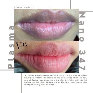 xóa nếp nhăn môi - Plasma fibroblast nano 347 xoa nep nhan moi 2