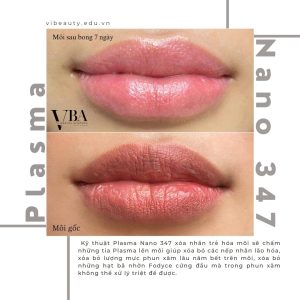 xóa nếp nhăn môi - Plasma fibroblast nano 347 xoa nep nhan moi 3