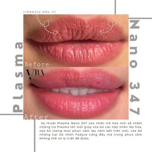 xóa nếp nhăn môi - Plasma fibroblast nano 347 xoa nep nhan moi 4