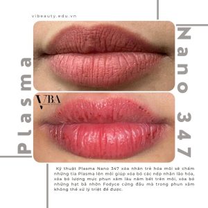xóa nếp nhăn môi - Plasma fibroblast nano 347 xoa nep nhan moi 5