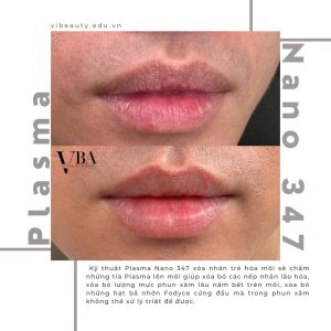xóa nếp nhăn môi - Plasma fibroblast nano 347 xoa nep nhan moi 6