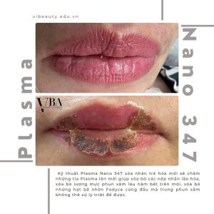 xóa nếp nhăn môi - Plasma fibroblast nano 347 xoa nep nhan moi 7