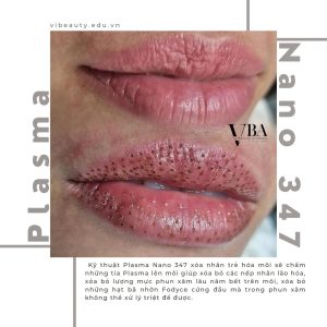 xóa nếp nhăn môi - Plasma fibroblast nano 347 xoa nep nhan moi 8