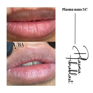 Plasma Fibroblast - xóa nếp nhăn môi hiệu quả 2 xóa nếp nhăn môi - Plasma fibroblast nano 347 xoa nep nhan moi 9