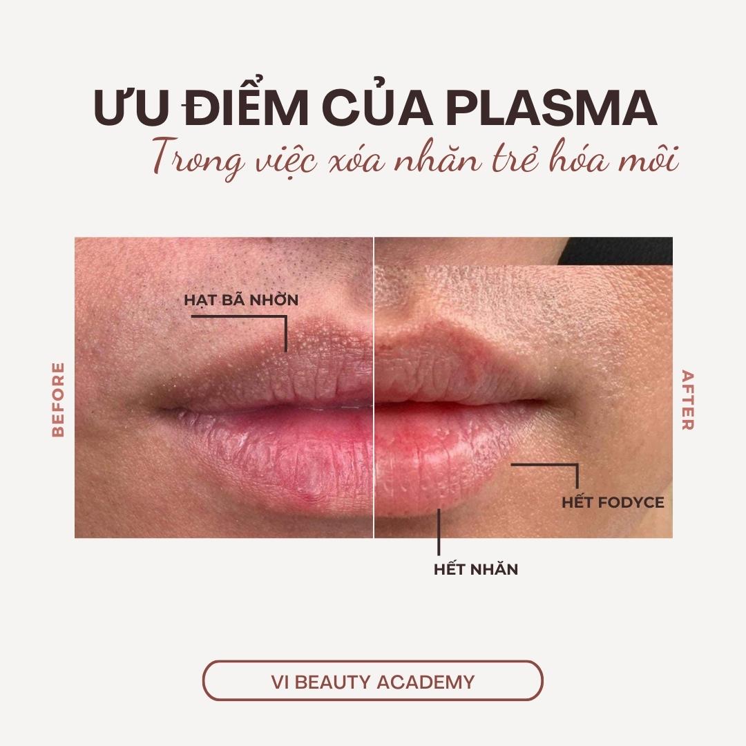 Uu-diem-xoa-nep-nhan-moi-bang-plasma-fibroblast xóa nếp nhăn môi - Uu diem xoa nep nhan moi bang plasma fibroblast