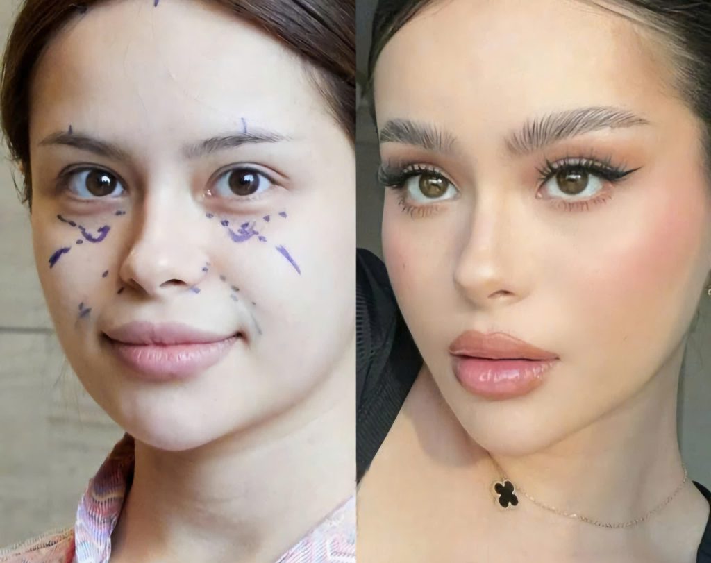 "Lột xác" vẻ đẹp rạng ngời cùng Plasma Fibroblast: Khám phá Khóa Học Plasma tại Vi Beauty Academy! 2 khóa học plasma - plasma truoc sau